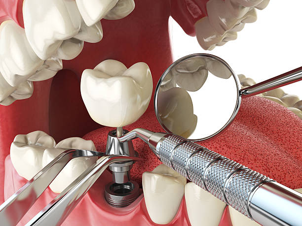 Best Emergency Dental Extractions in Dillsburg, PA